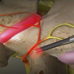 cervical facet radiofrequency neurotomy