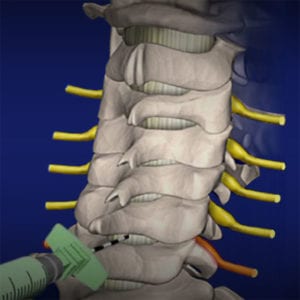 cervical epidural steroid injections