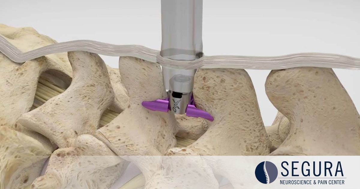 Superion Implant for Lumbar Stenosis