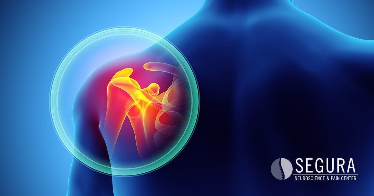 Radiofrequency Ablation for Shoulder Pain