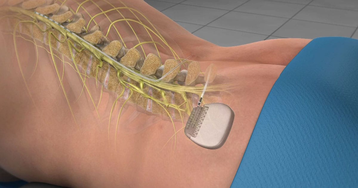 Spinal Cord Stimulator Versus Spinal Fusion