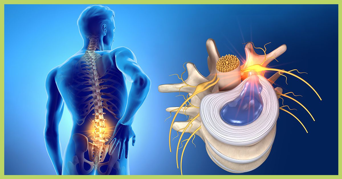 Herniated Disc Segura Neuroscience Pain Center