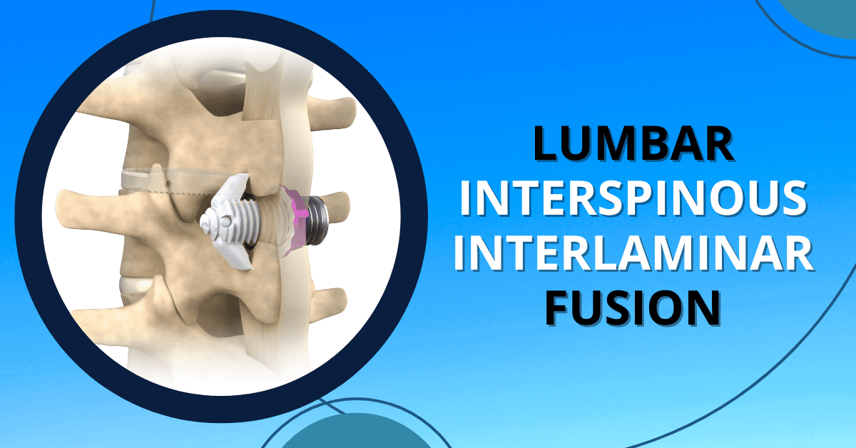 Lumbar Interspinous-Interlaminar Fusion